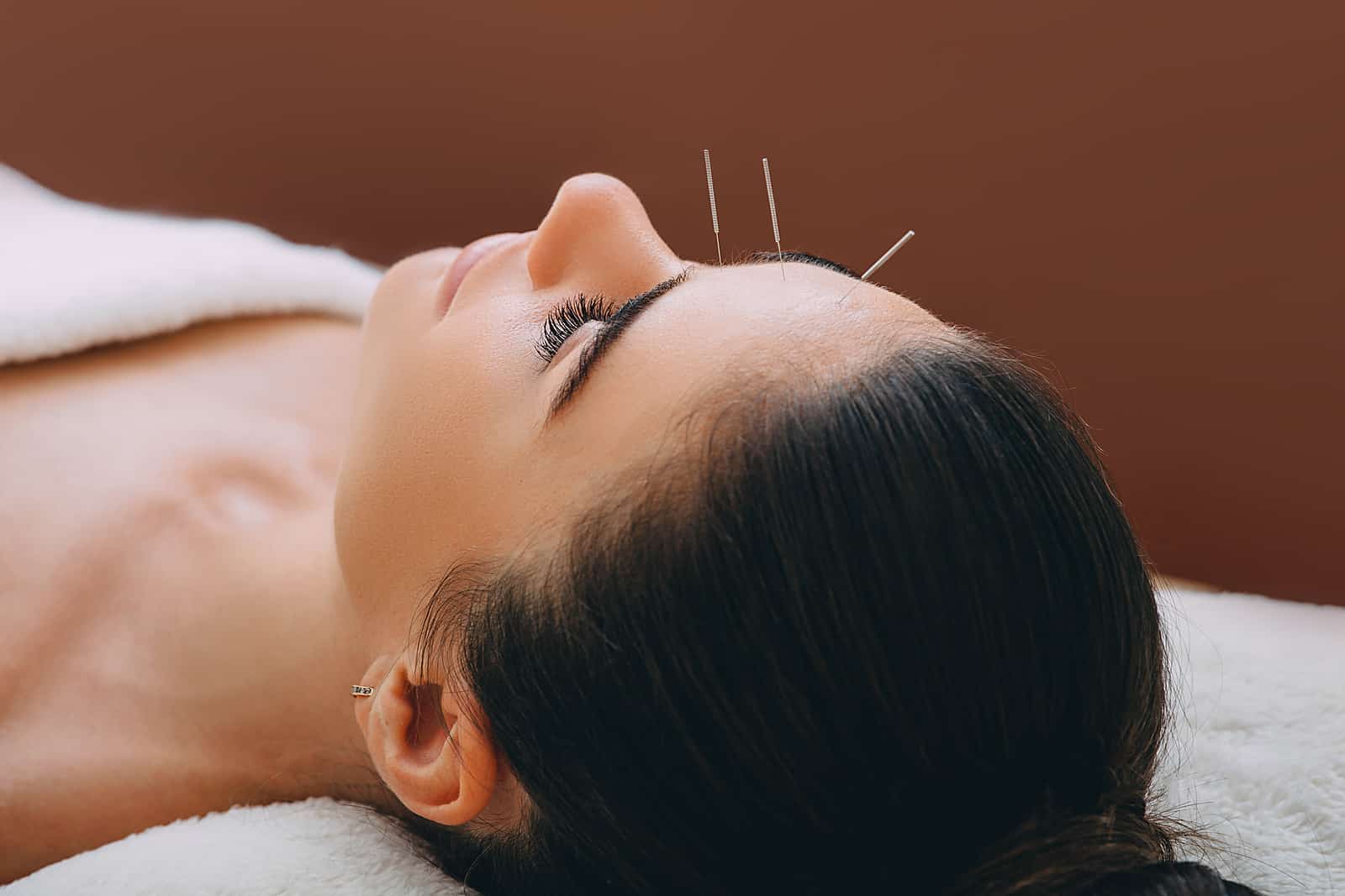 Beautiful woman received an acupuncture  - easy pain management tehniques