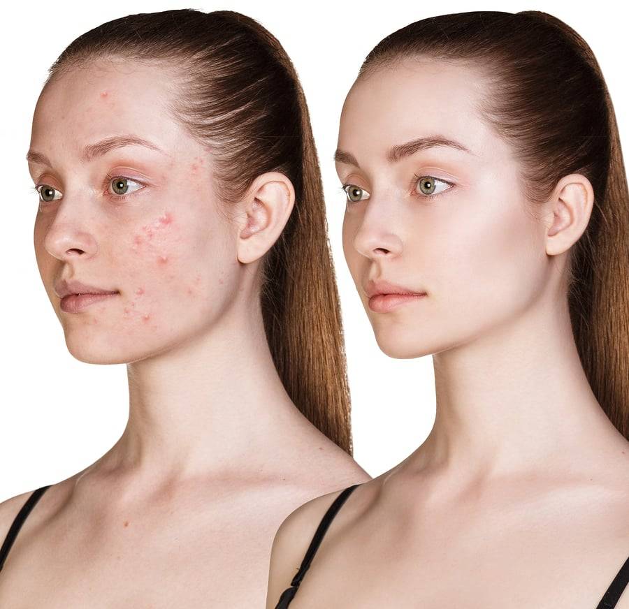 Acne