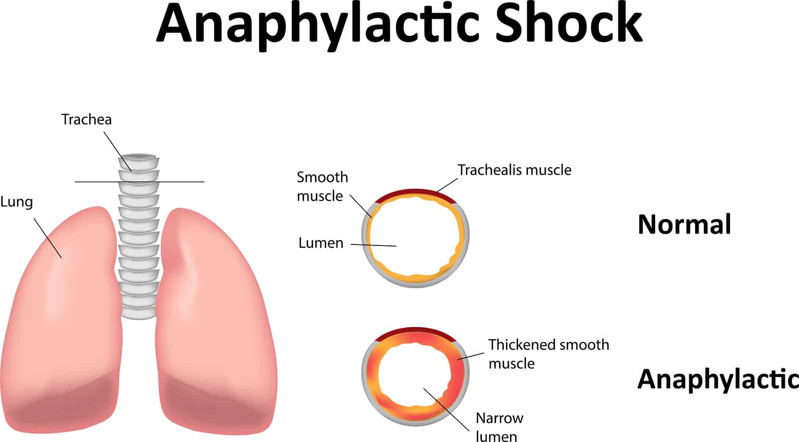Anaphylactic Shock Illustration