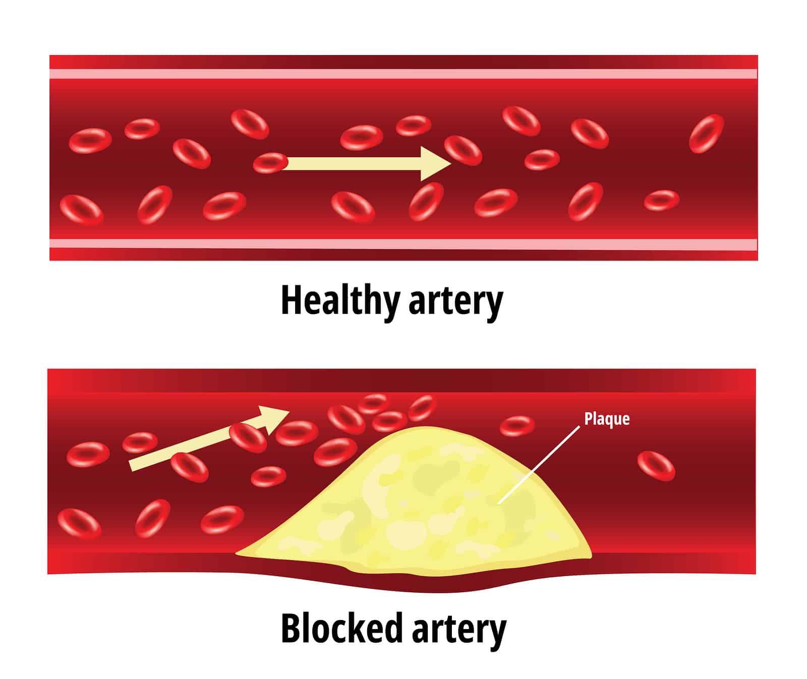 Blocked artery, fat stuck in the blood artery