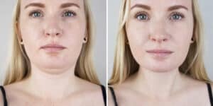 How To Lose Face Fat A Beginner's Guide (3)