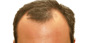 White Lupine Your Natural Ally Against Hair Loss (1)