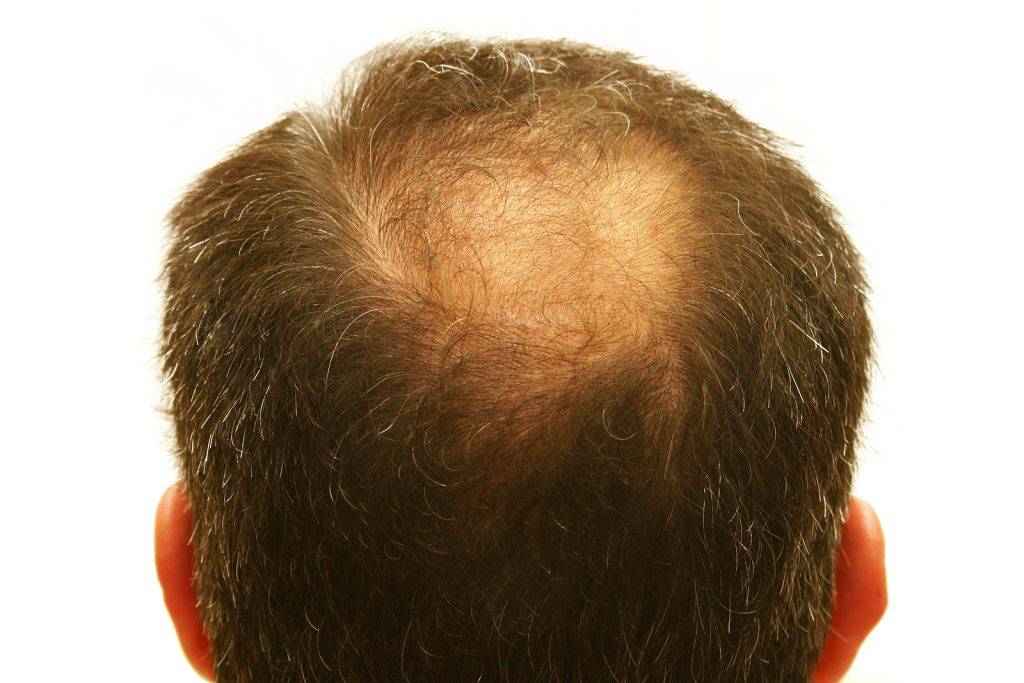 Balding Head